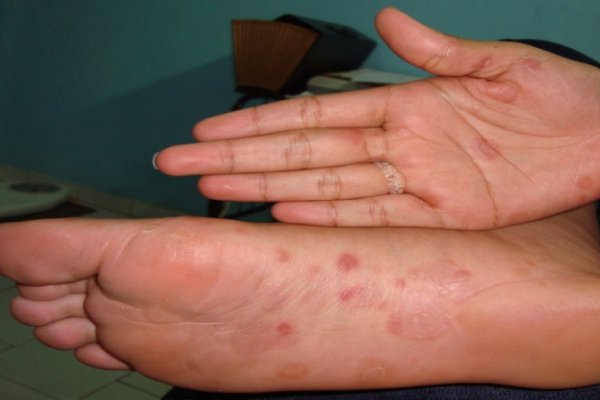 Sífilis: una enfermedad sumamente contagiosa y, a la vez, de muy fácil tratamiento