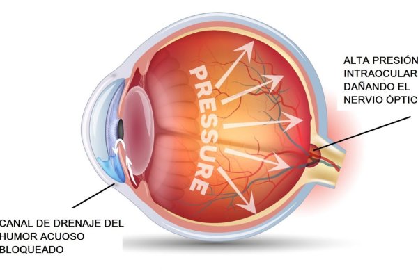 ¿Que es el Glaucoma?